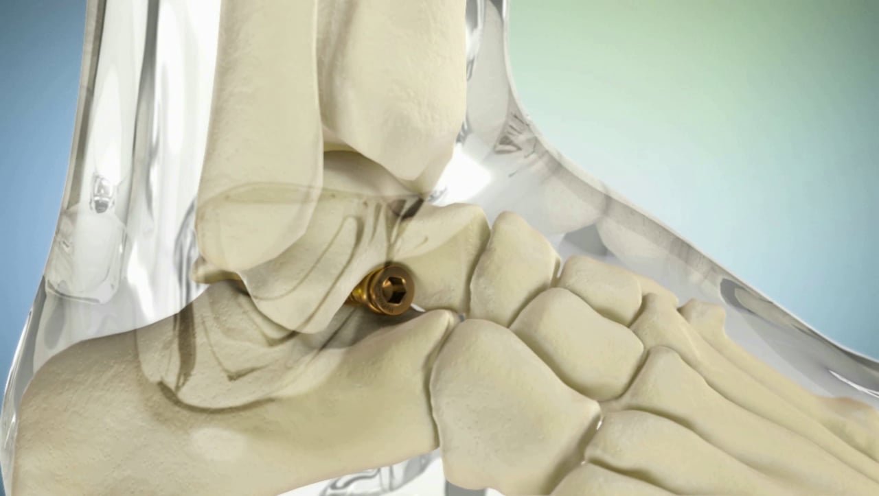 HyProCure Titanium Foot Implant (Right side, round 1