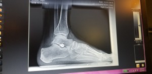 X-ray from side